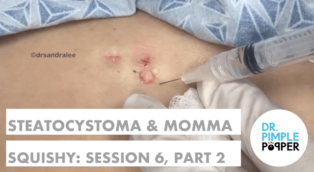 Steatocystomas & Momma Squishy: Session Six, Part 2A