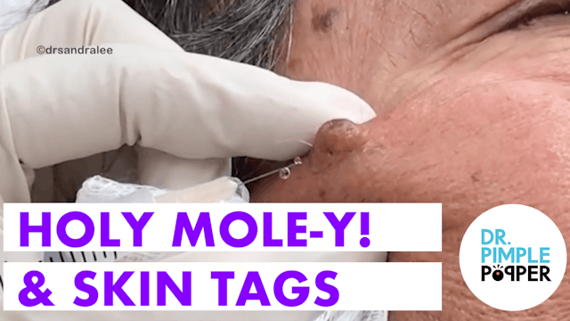 Skin Tags & A Mole!
