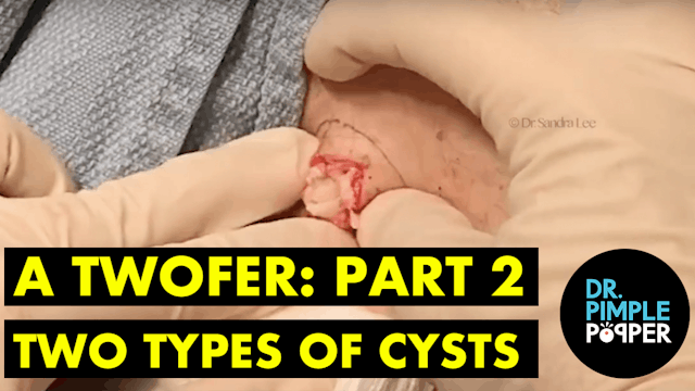 A Twofer: Part Two - Two Types of Cysts