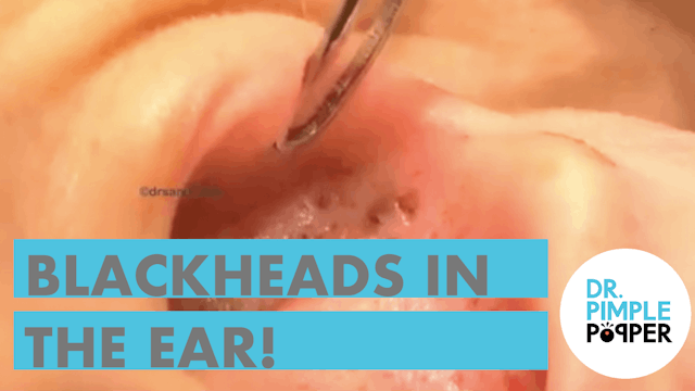 Blackheads in the Ear of Ms Rainbow S...