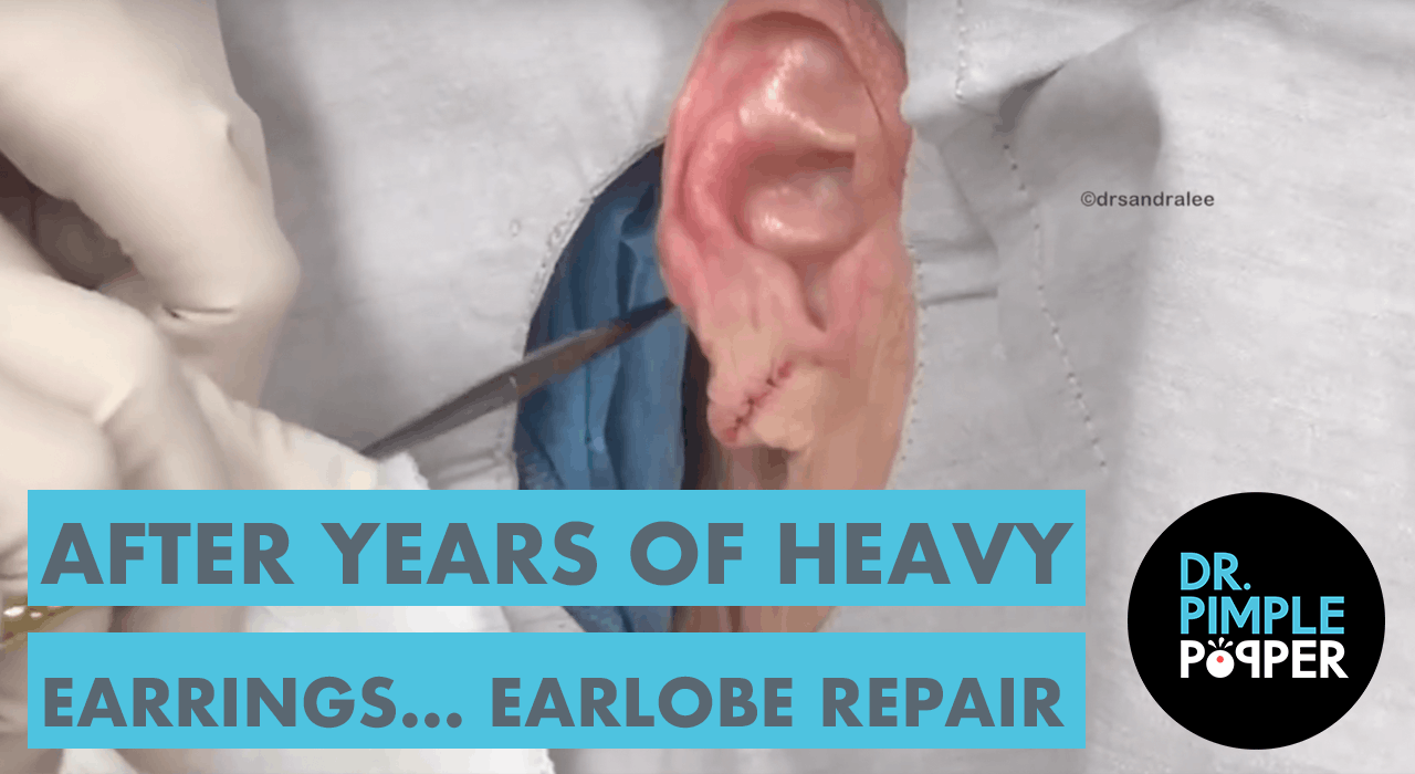 After Years of Wearing Heavy Earrings... Earlobe Repair A Day in