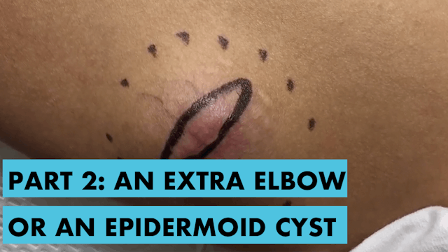 An Extra Elbow, a Floatation Device, or an Epidermoid Cyst - Part 2 of 2