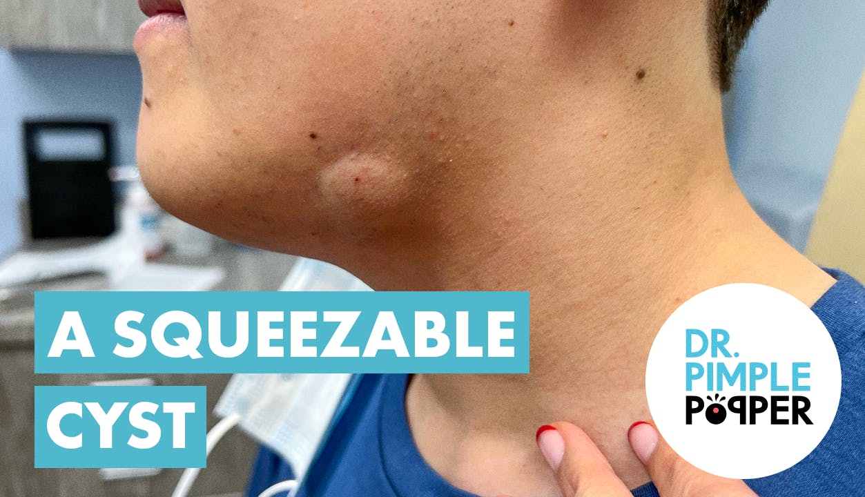 A Squeezable Cyst! Dr. Pimple Popper