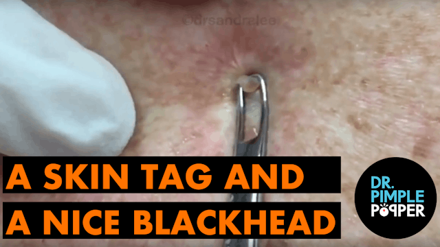 A tag and a nice blackhead.