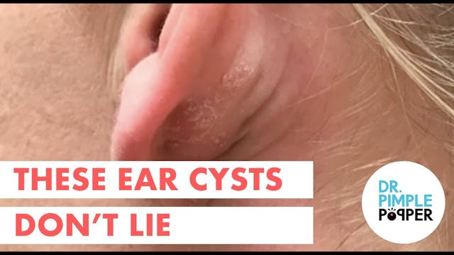 These Ear Cysts Don't Lie