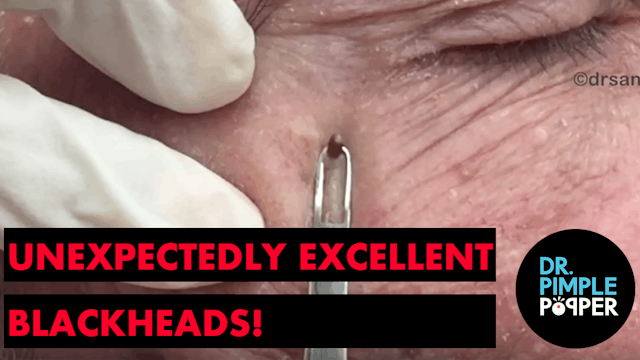 Blackheads or Sebaceous Filaments on the Nose? Extractions