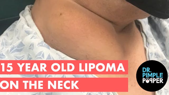 15 Year Old Lipoma on the Neck