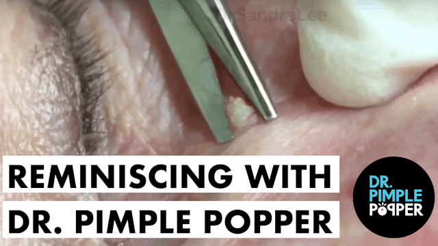 Reminiscing with Dr. Pimple Popper- TBT