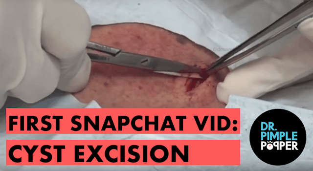 First Snap Chat Vid: Cyst Excision