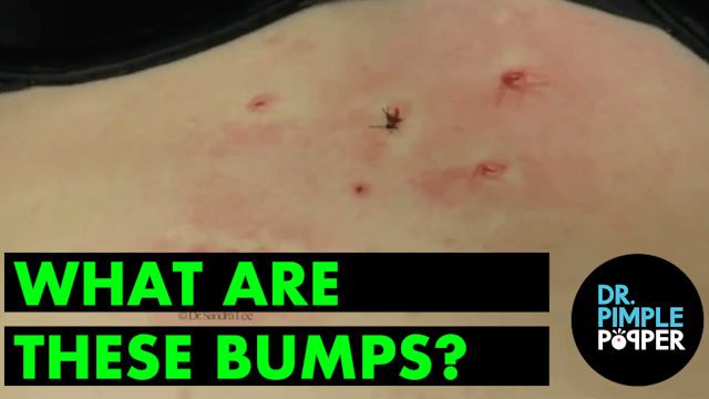 What are these bumps? Watch how we ar...