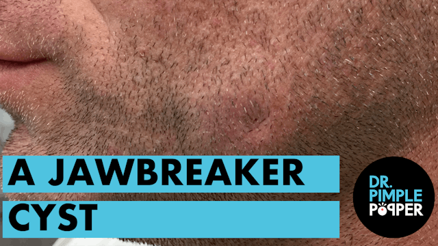 A Jawbreaker Cyst