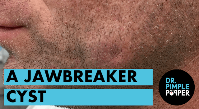 A Jawbreaker Cyst