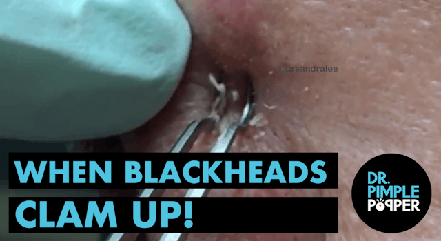 When Blackheads Clam Up!