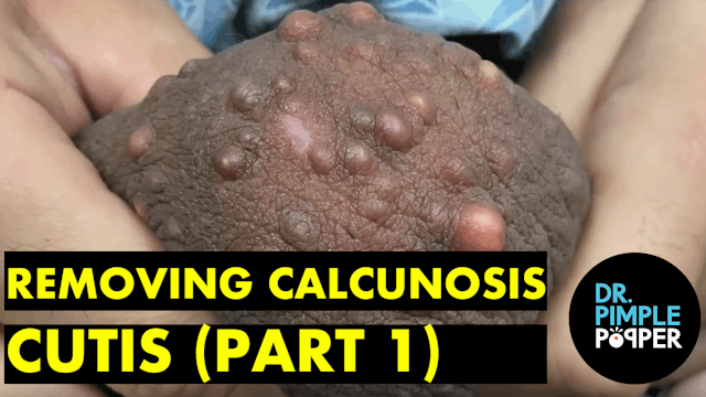 Removing Calcinosis Cutis (Part 1)