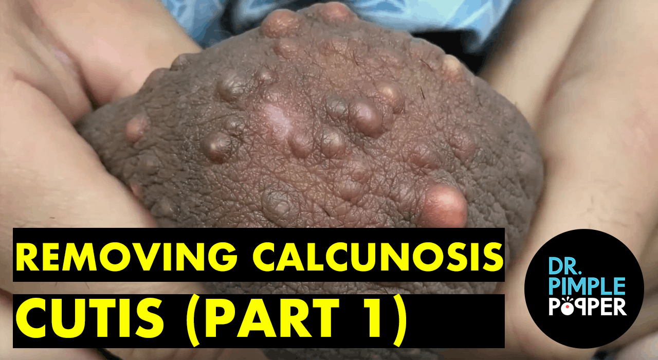 calcinosis face