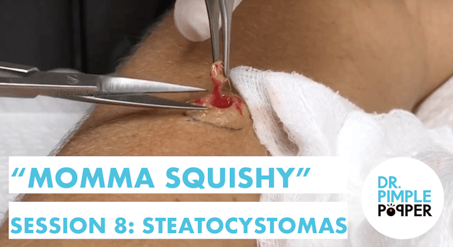 Happy Birthday Popping with Momma Squishy & Dr Pimple Popper: Session 8