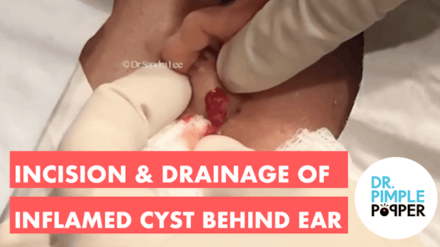 Incision & Drainage of Inflamed Cyst ...