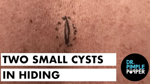 Two Small Cysts in Hiding