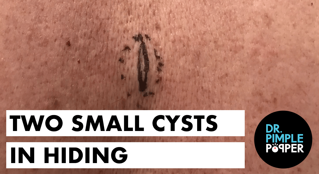 Two Small Cysts In Hiding Oozy Offerings Dr Pimple Popper