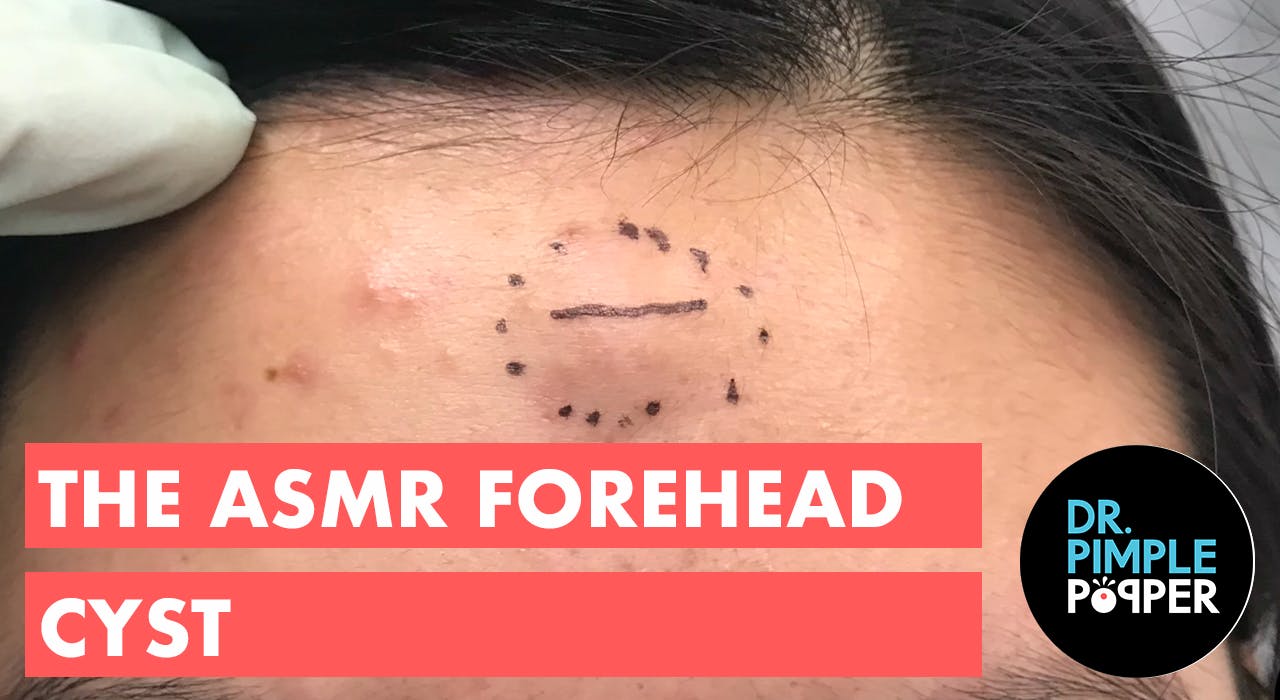 the-asmr-forehead-cyst-dr-pimple-popper