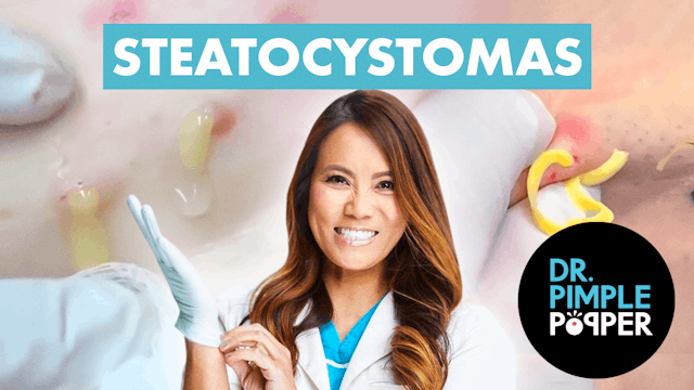60 Minutes of Steatocystomas That Altered My Brain Chemistry