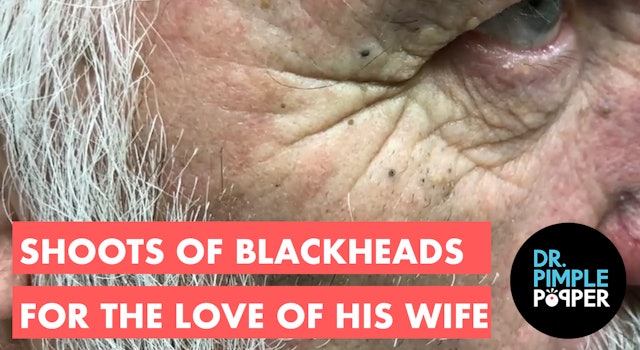 Shoots of Blackheads for the Love of His Wife 