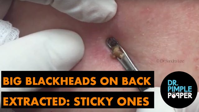 Big Blackheads on the Back, Extracted...