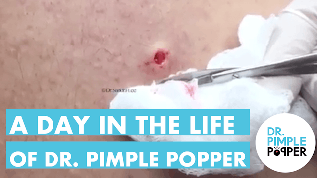 Just a Day in the Life of Dr Pimple Popper: DermDays