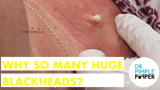Why so many HUGE BLACKHEADS? Session ...