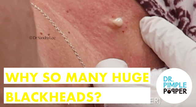 Why so many HUGE BLACKHEADS? Session 1! "Momma Squishy"