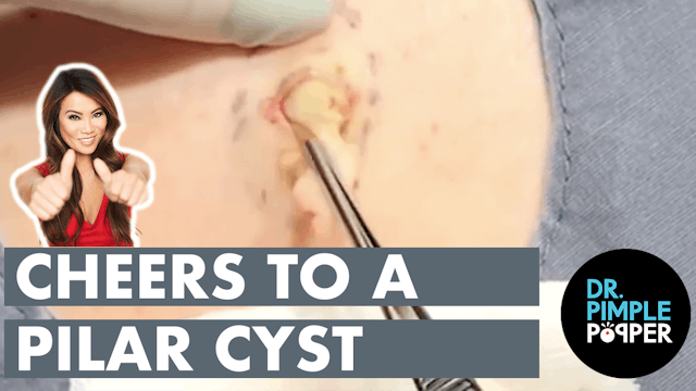 Queen of Pops' Pick: Cheers to a Pilar Cyst