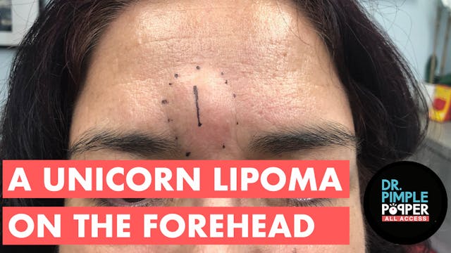 FIRST LOOK: The Unicorn Lipoma