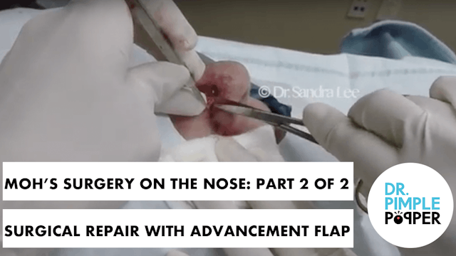 Mohs Surgery on the nose: Part 2 of 2, Surgical Repair with Advancement Flap