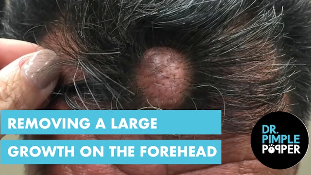 Removing this Large Growth on the Frontal Scalp of a very nervous patient