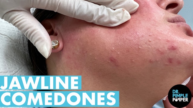 Pinching & Extracting Jaw Comedones Part 2 All-Access with Dr Pimple Popper