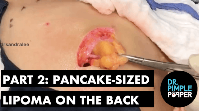Part 2: A Pancake-Sized Lipoma on the...