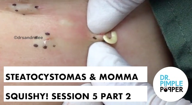 Steatocystomas & Momma Squishy: Session Five, Part 2