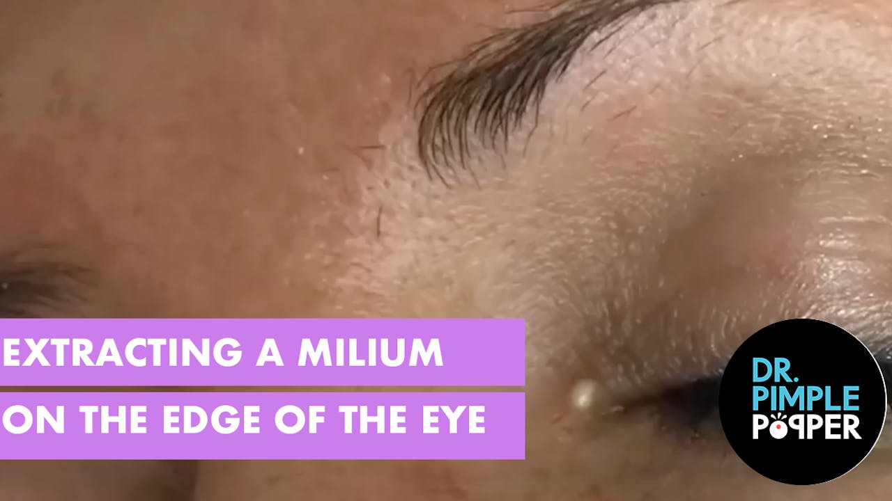 Extracting a Milia on the Edge of the Eye - Milia Madness - Dr. Pimple