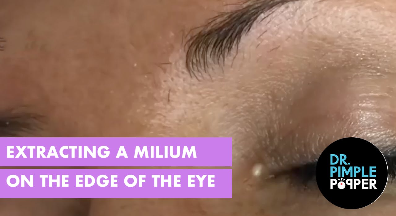 Extracting A Milia On The Edge Of The Eye Milia Madness Dr Pimple