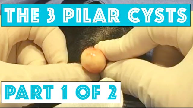 The Story of 3 Pilar Cysts: Part 1 of 2 