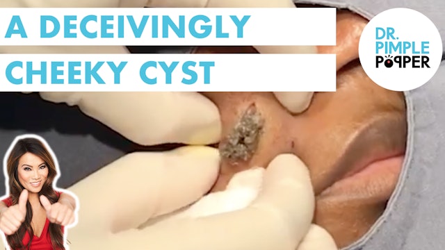 A Deceivingly Cheeky Cyst