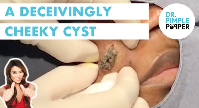 A Deceivingly Cheeky Cyst