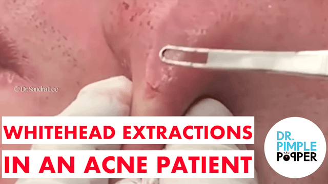 Whitehead Extractions in an Acne Patient