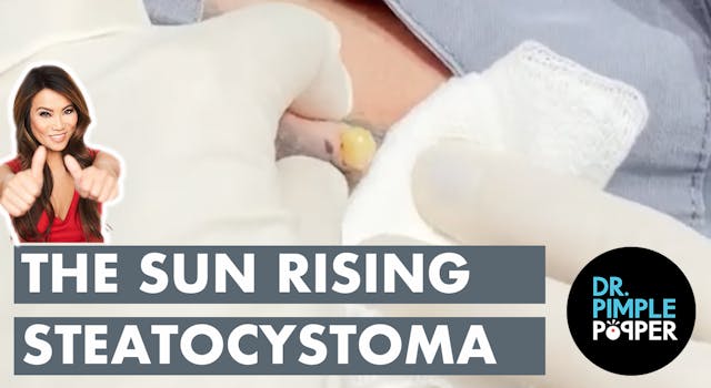 The Sun Rising Steatocystoma