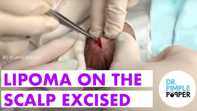 Lipoma on the Scalp Excised