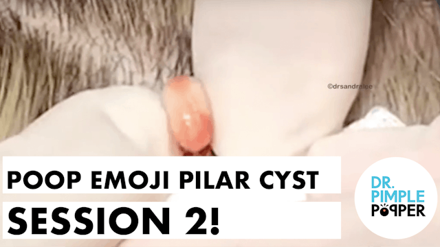 Poop Emoji Pilar Cyst - Session 2!