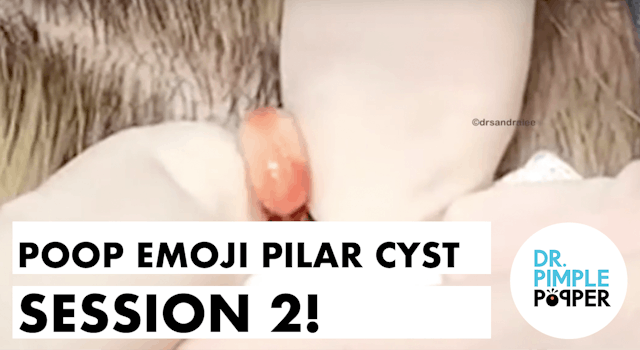 Poop Emoji Pilar Cyst - Session 2!