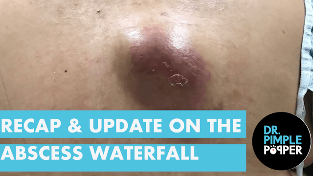 Recap & Updates on the Abscess Waterfall