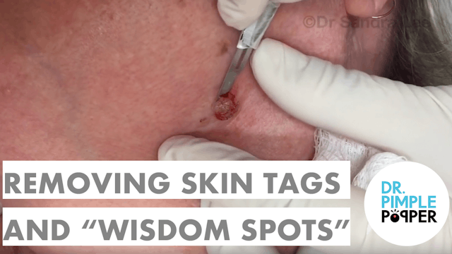 Removing Skin Tags and "Wisdom Spots"