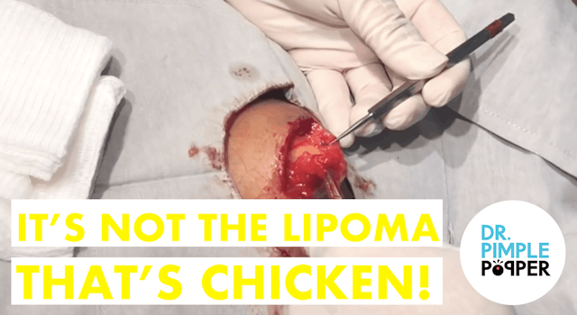 It's Not The Lipoma That's Chicken